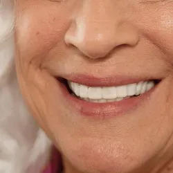 لمینت دندان دو فک مدل TruSmile به همراه نوار چسب سفیدکننده دندان