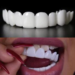 لمینت دندان دو فک مدل Snap on Smile