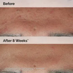 سرم ضد جوش Niacinamide 10% + Zinc 1% اوردینری حجم 30 میلی لیتر